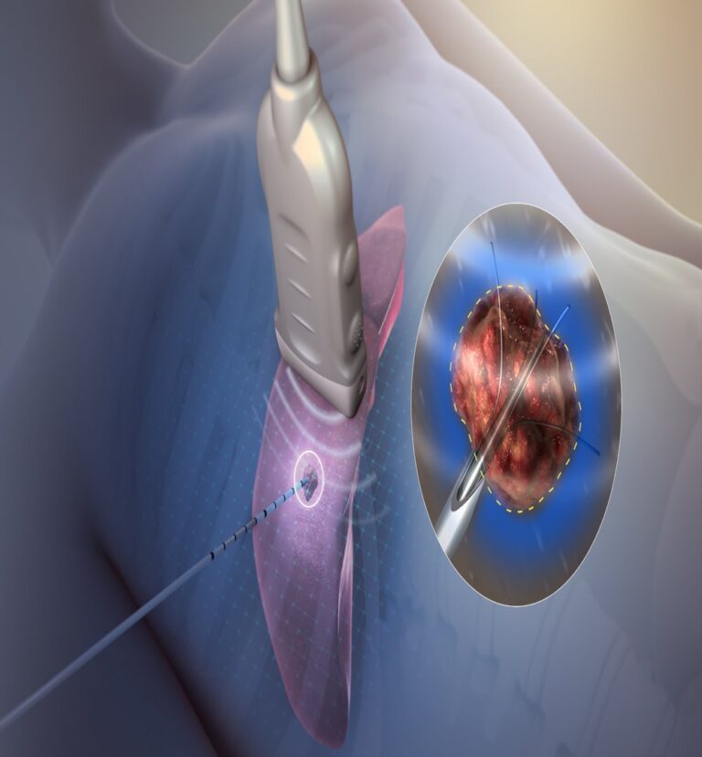 Illustration of an endoscope at the spine
