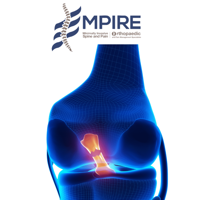 Illustration of a knee ligament injury