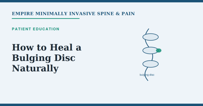 Illustration of a bulging disc in the spine