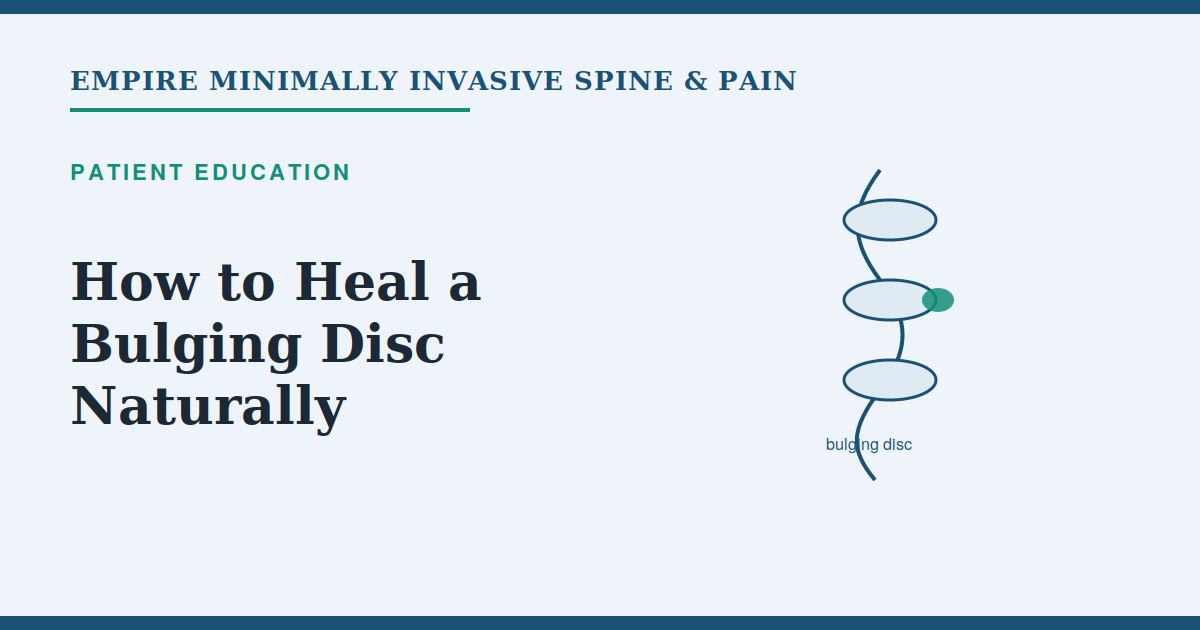 Illustration of a bulging disc in the spine