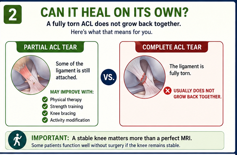 Torn ACL - Partial vs Complete Tear