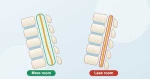 Illustration of the lower spine: leaning forward gives the spinal nerves more room, arching backward narrows the canal in spinal stenosis